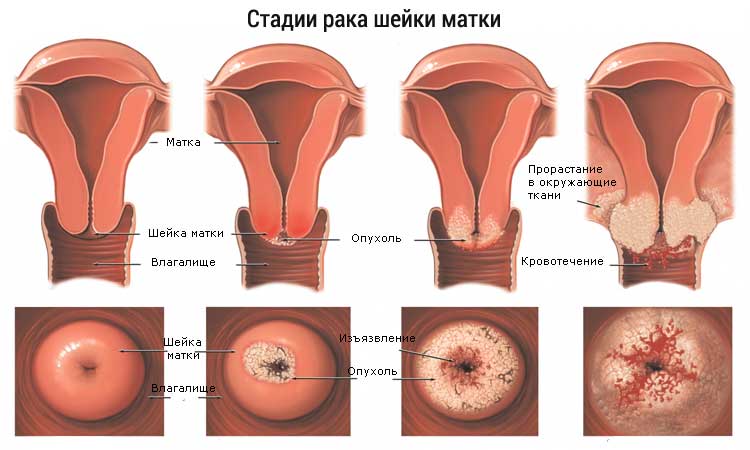 Эрозия шейки матки рак