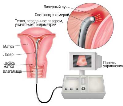 Гиперплазия эндометрия лазером