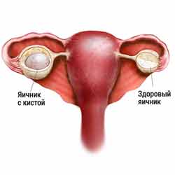 Киста яичника