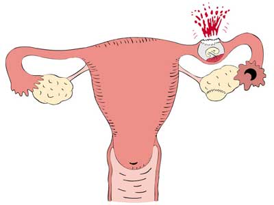 Внематочная беременность лечение